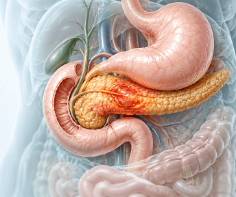 Pancreatitis at Arihant Hospitals