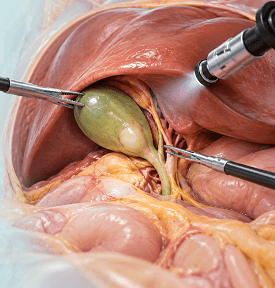 Laparoscopic Cholecystectomy at Arihant Hospitals