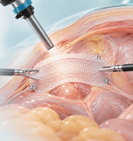 Laparoscopic Hernia Repair at Arihant Hospitals