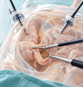 Laparoscopic Appendectomy at Arihant Hospitals