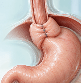 Nissen Fundoplication at Arihant Hospitals